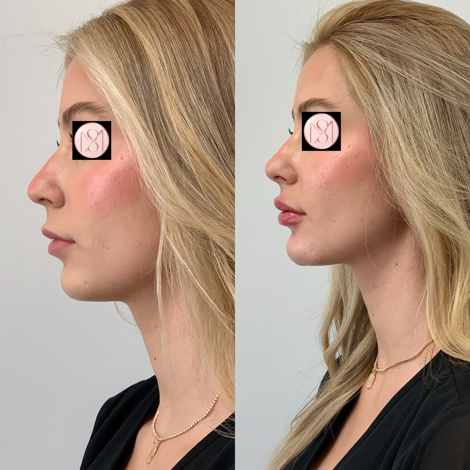 Resultado antes e depois — caso 10