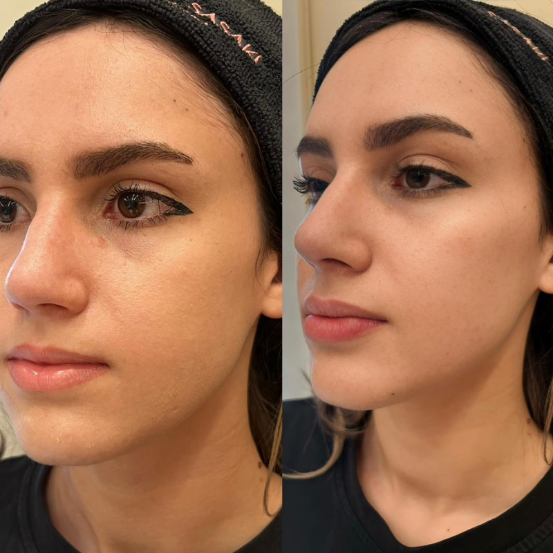 Resultado antes e depois — caso 1