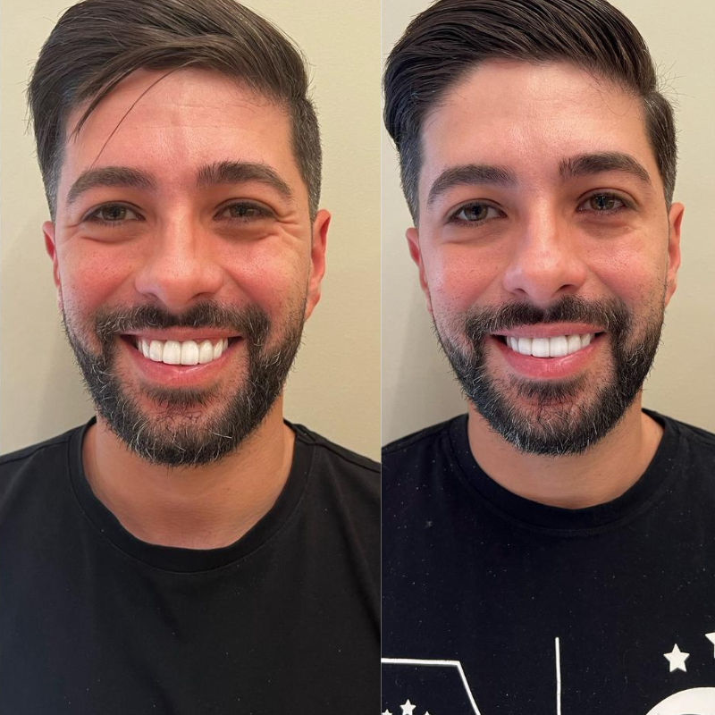Resultado antes e depois — caso 2