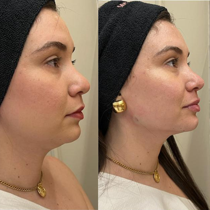 Resultado antes e depois — caso 4