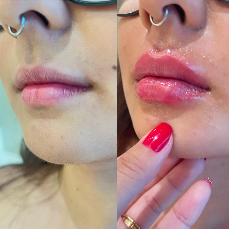 Resultado antes e depois — caso 5