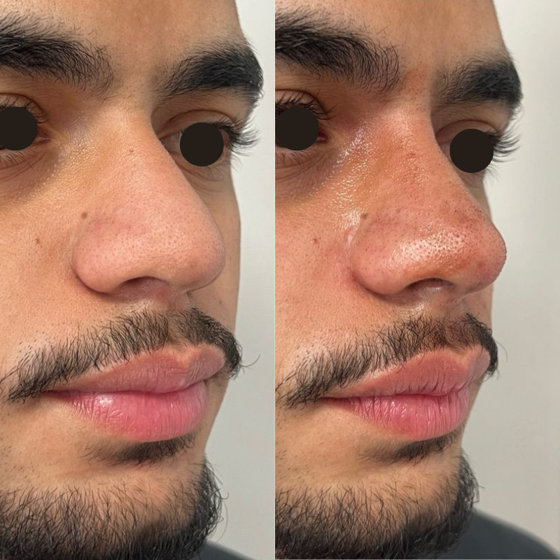 Resultado antes e depois — caso 9